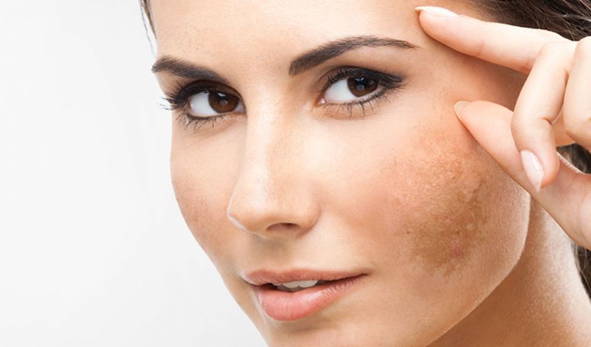 Macchie sulla pelle del viso: prevenzione e trattamento cosmetico